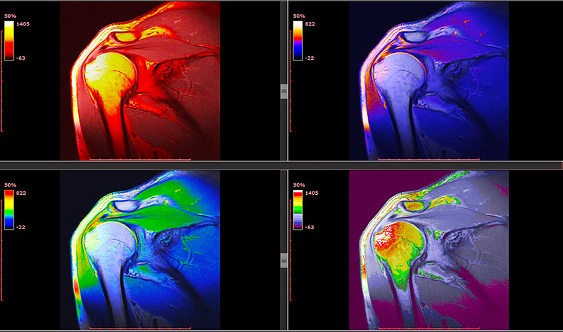 Schulterverletzungen im MRT Bild in verschiedenen Farben