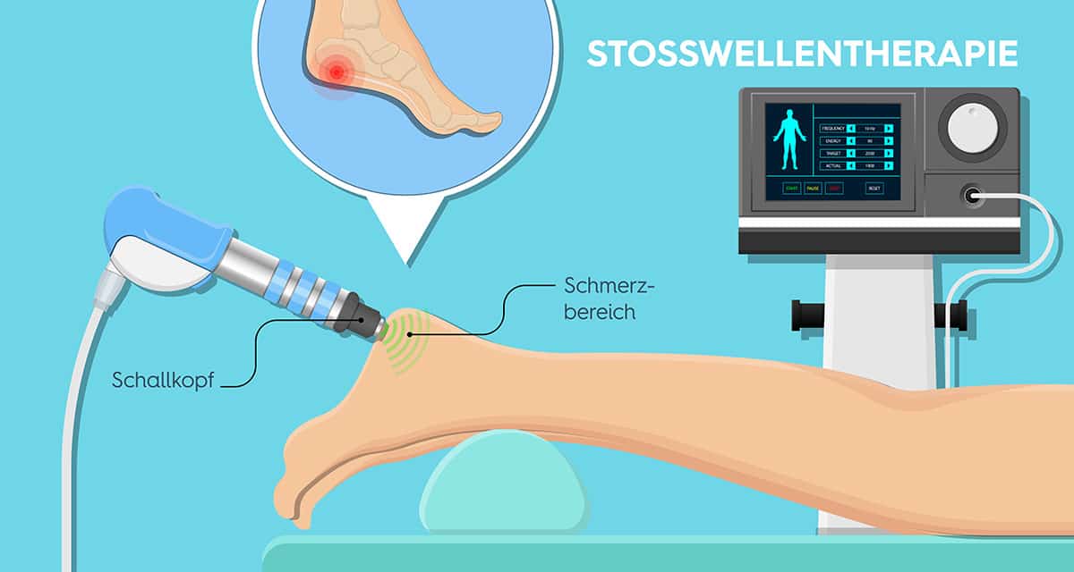 Schaubild von einer Stosswellentherapie Anwendung am Fuß - Schallkopf wird an die Fersen, den Schmerzbereich angelegt, ein Monitor zeigt die Intensität an - Comic Style