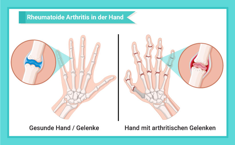 Schaubild einer gesunden Hand und einer Hand mit arthritischen Gelenken