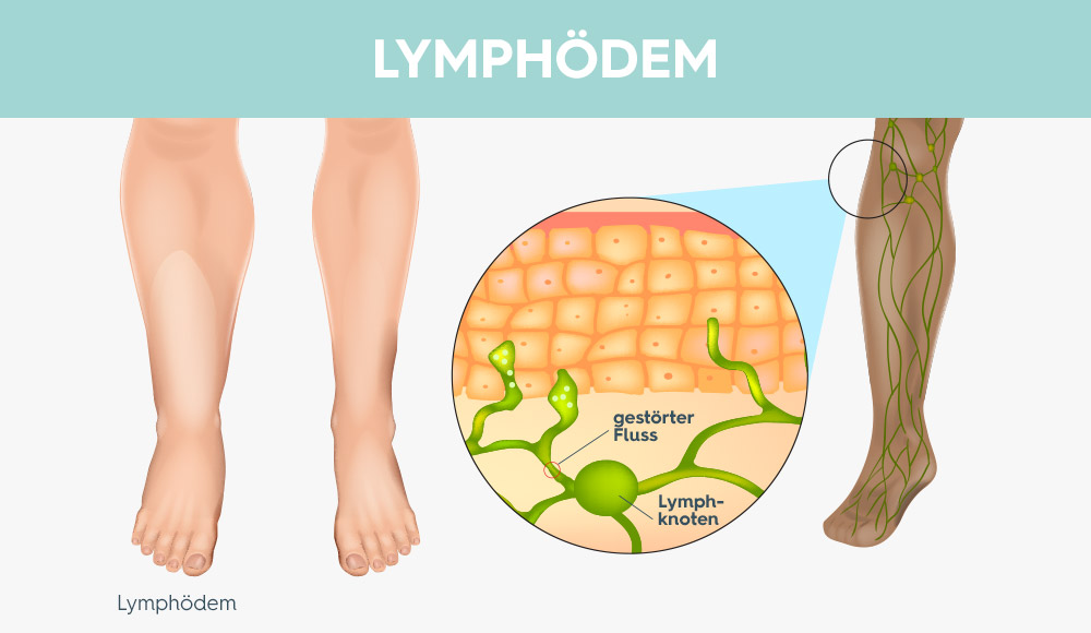Das Lymphödem erklärt mit Zeichnungen von Lymphgefäßen, Lymphknoten und einem geschwollenen Bein