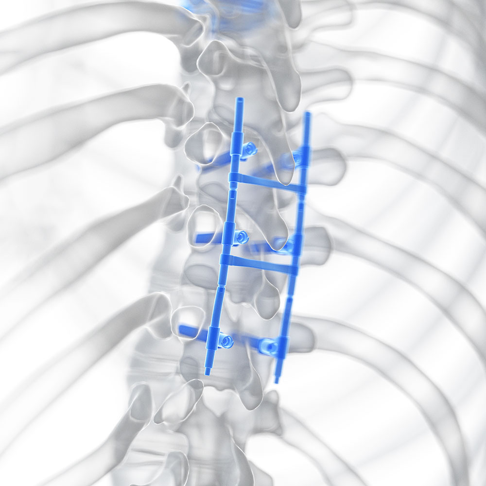 3D Bild einer Schiene an der Wirbelsäule
